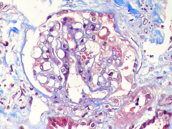 Paediatric Nephrotic Syndrome